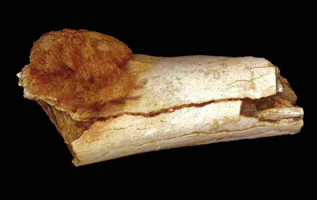 Scientists using a high-resolution X-ray technique found that this bone belonging to a hominin, an ancient, extinct relative of modern humans, has a malignant tumor.