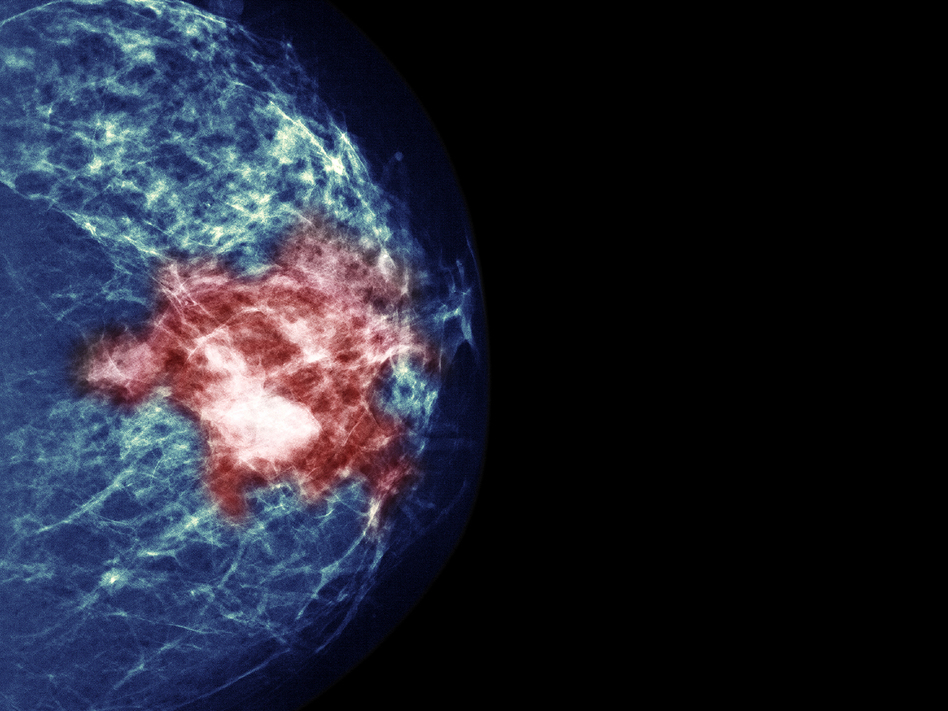 By testing tumors, researchers hoped to identify women who could avoid chemotherapy without increasing their risk of a cancer recurrence. (Voisin/Phanie/Science Source)
