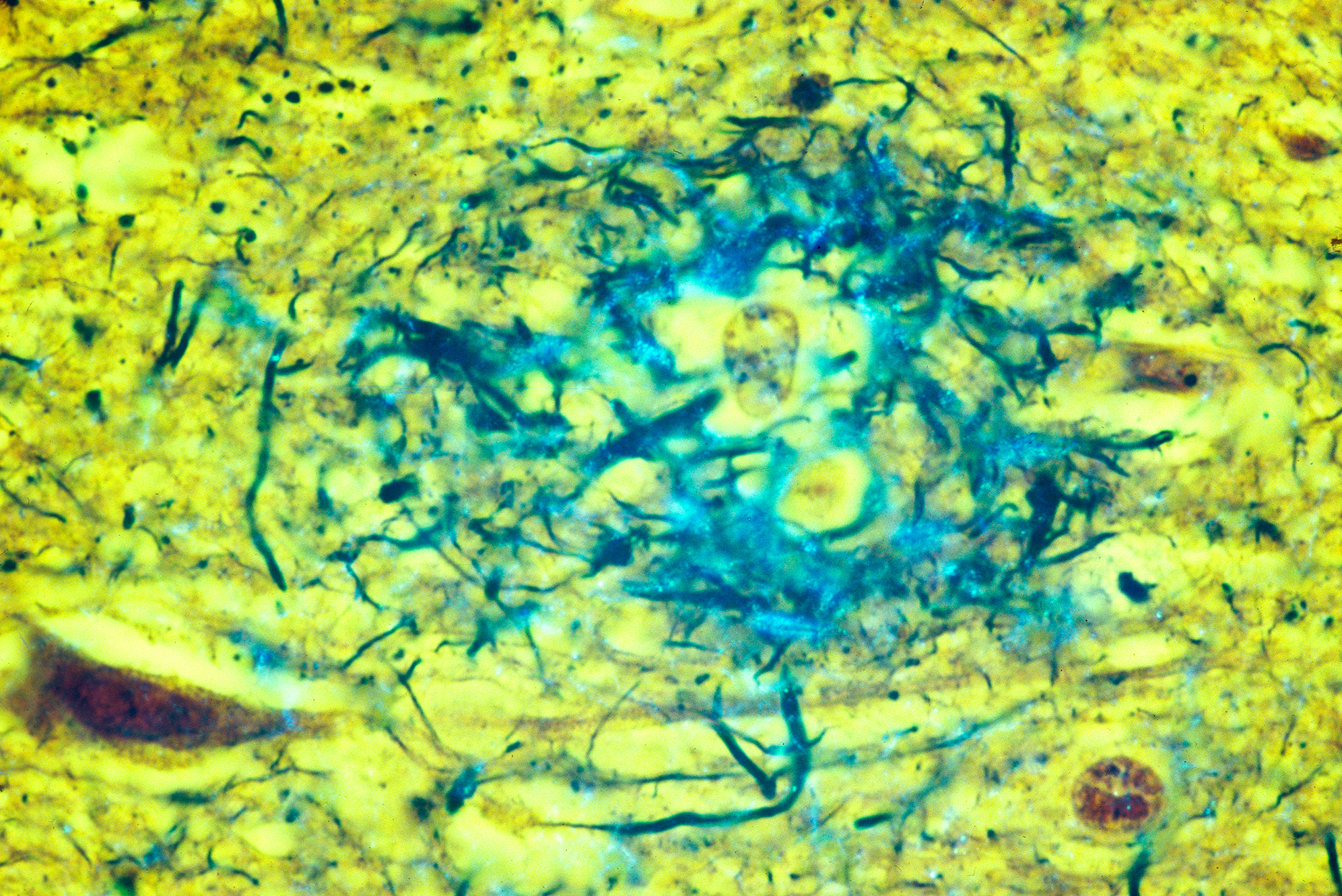 Diseased brain tissue from an Alzheimer's patient showing amyloid plaques (in blue) located in the gray matter of the brain. (Science Source/Getty Images)