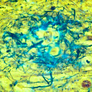 Where Does Alzheimer's Treatment Go From Here?