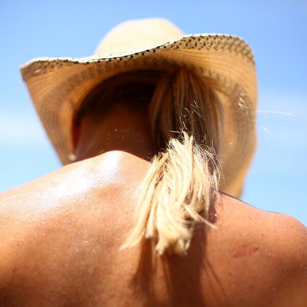 Some Melanoma Survivors Are Still Getting Too Much Sun Exposure