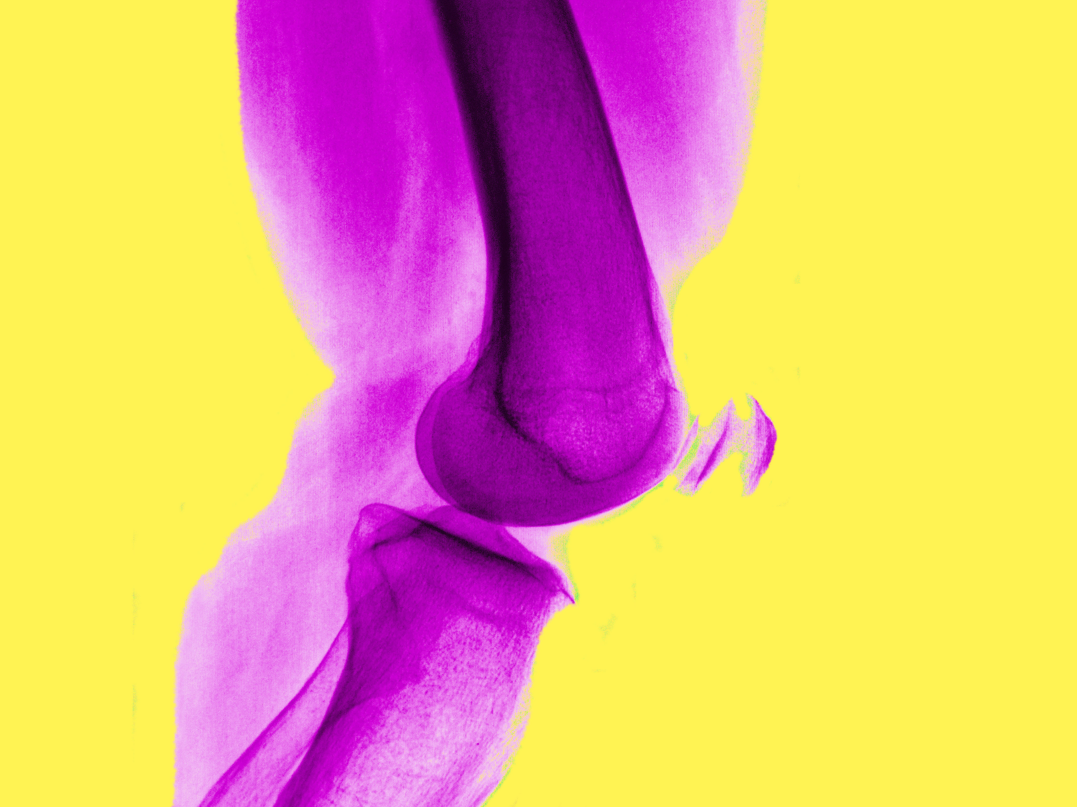 Experts say no to surgery for arthritic knees