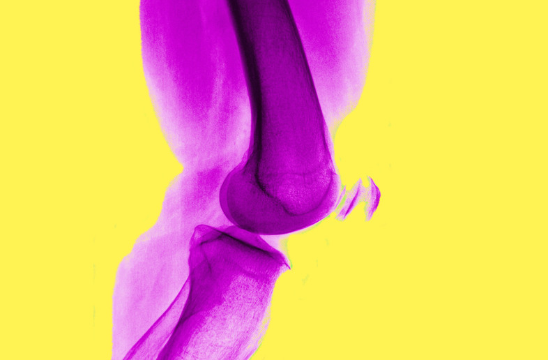 Arthritis of the knee is very common, and isn't helped by arthroscopic surgery, a study finds. (BSIP/UIG via Getty Images)
