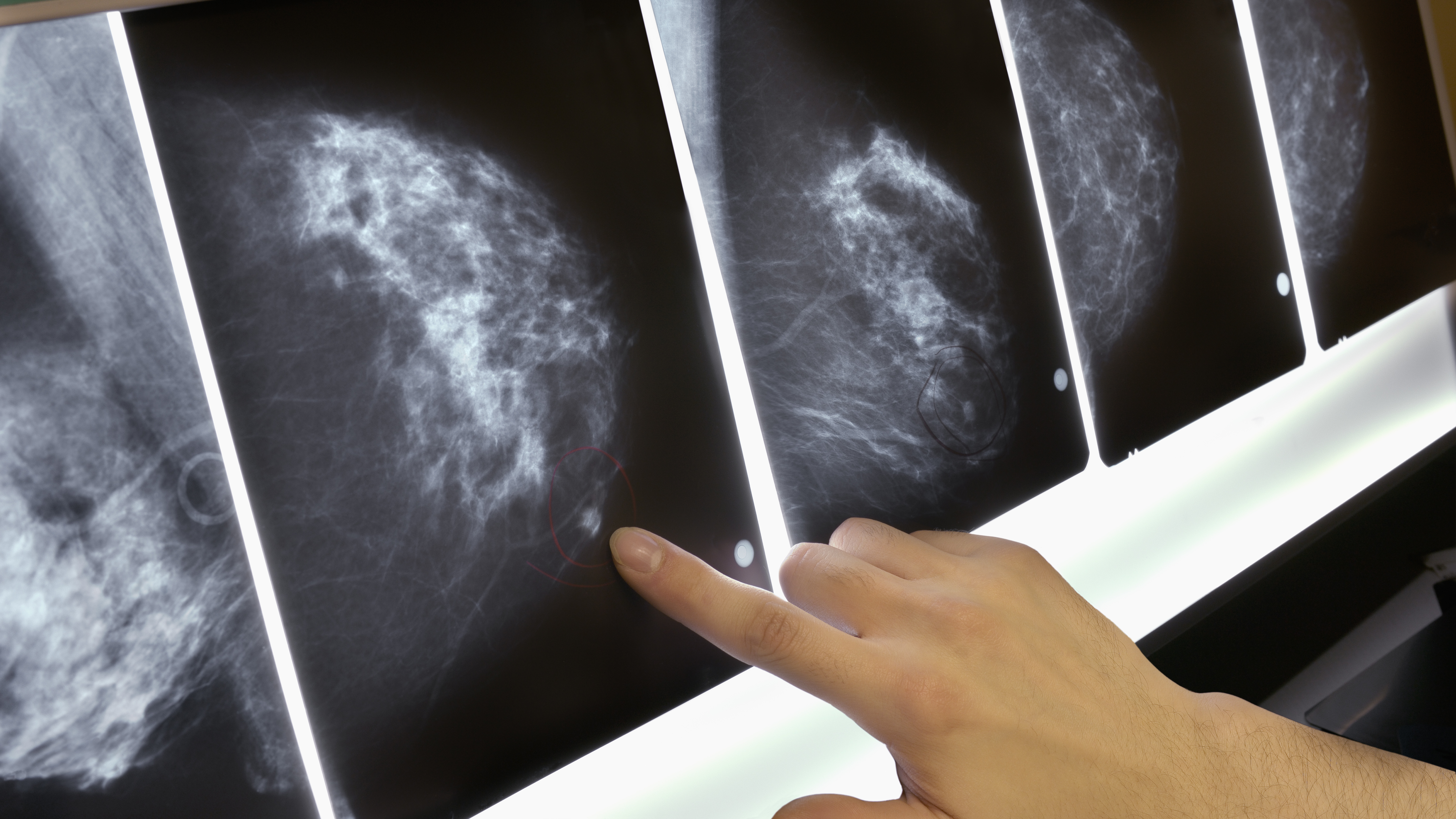 Early Breast Cancer May Not Carry High Risk : Shots - Health News : NPR