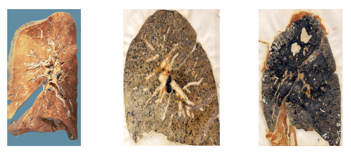 Sliced sections of lungs show the damage and disease caused by excessive exposure to coal and silica dust. The middle slide depicts a lung with fibrotic tissue resulting from simple coal workers' pneumoconiosis or black lung. The slide on the right shows hardened and blackened lung tissue when black lung disease reaches its most advanced stage. (Courtesy of the National Institute for Occupational Safety and Health)