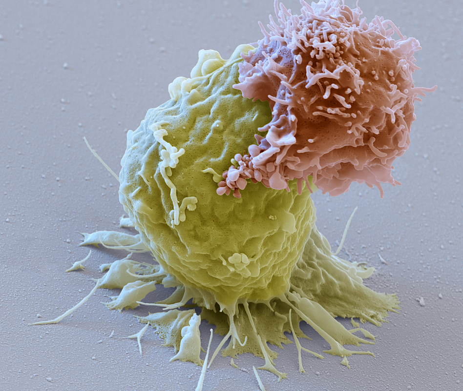 Image of a CAR-T cell (reddish) attacking a leukemia cell (green). These CAR-T lymphocytes are used for immunotherapy against cancer (CAR stands for chimeric antigen receptor). After the proliferation of the CAR-expressing T cells, they are transfused back into the patient and can directly detect the cancer cells carrying the antigen. (Eye of Science/Science Source)
