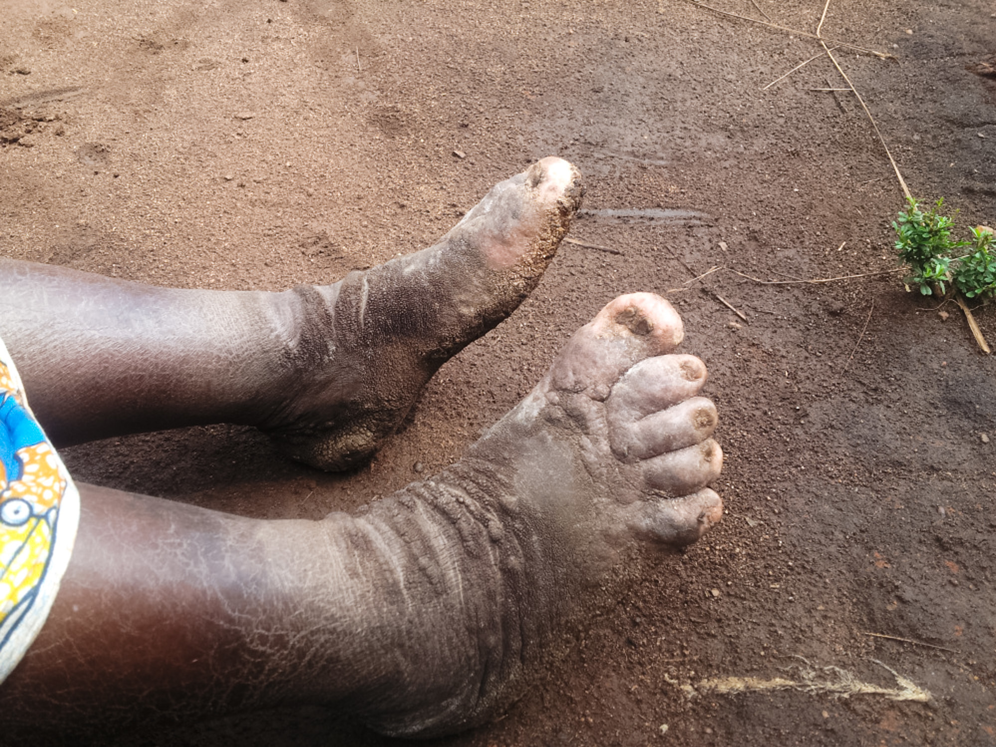 The typical asymmetrical lymphedema (lower limb swelling) seen in podoconiosis. The skin on the affected limbs is thickened with warty and mossy nodules. The toes are disfigured with joint fixation typical of advanced podoconiosis disease. (ASTMH & AJTMH)