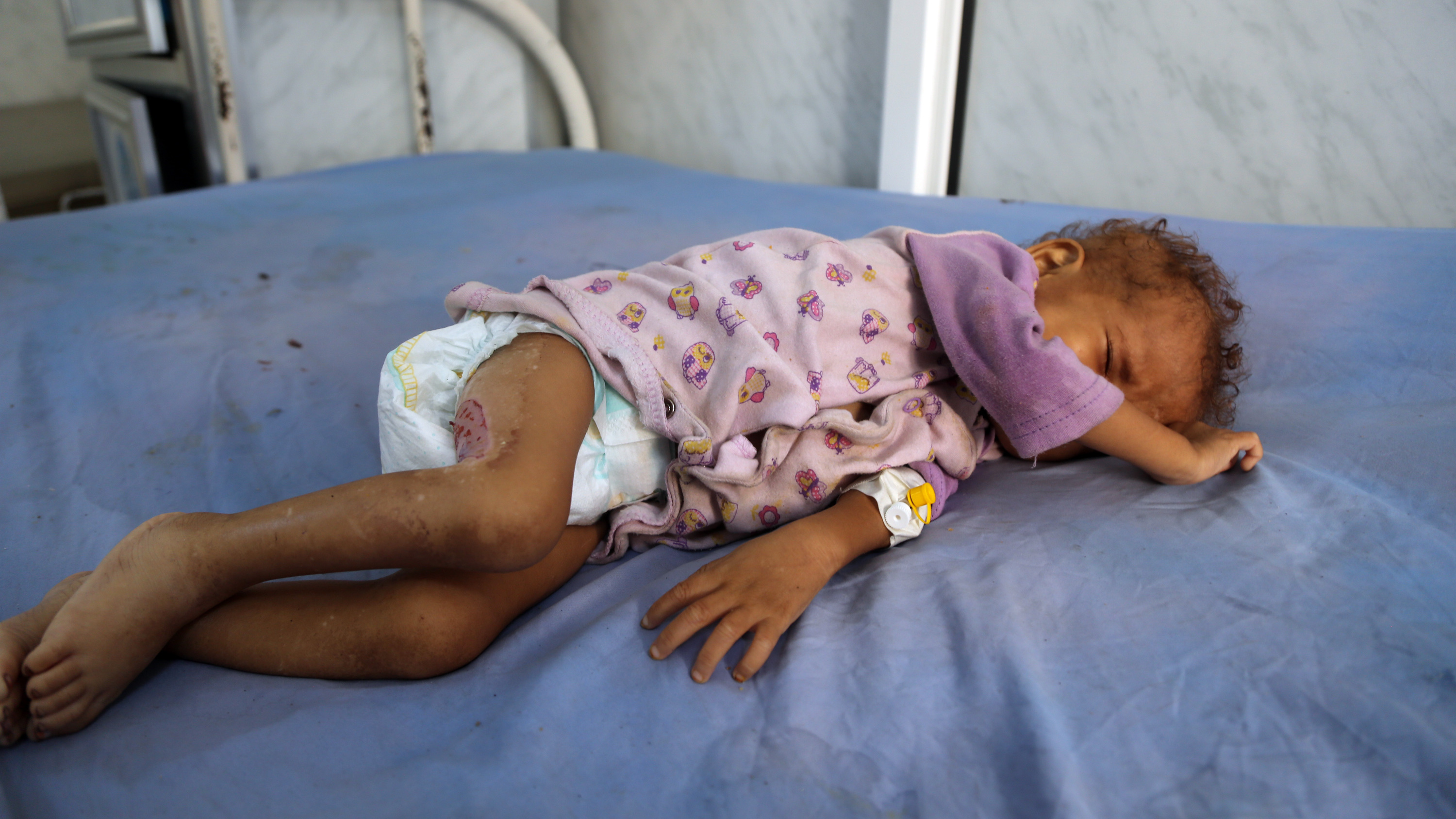 A malnourished Yemeni child receives treatment at a hospital in the port city of Hodeidah on Tuesday. Ravaged by cholera, famine and war, the country has been declared the world's worst humanitarian crisis — and there is little indication the dire situation there is improving. (AFP/Getty Images)