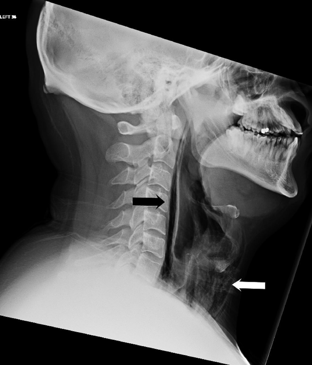 X ray deep throat image