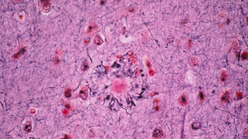 Key Molecule May Tie Immune Response To >> Brain S Ancient Immune System May Play A Role In Alzheimer S Shots Key Molecule May Tie Immune Response To >> Brain S Ancient Immune System May Play A Role In Alzheimer S Shots