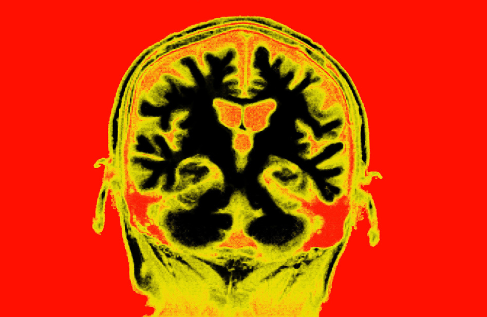 Brain MRI (BSIP/Collection Mix: Sub/Getty Images)