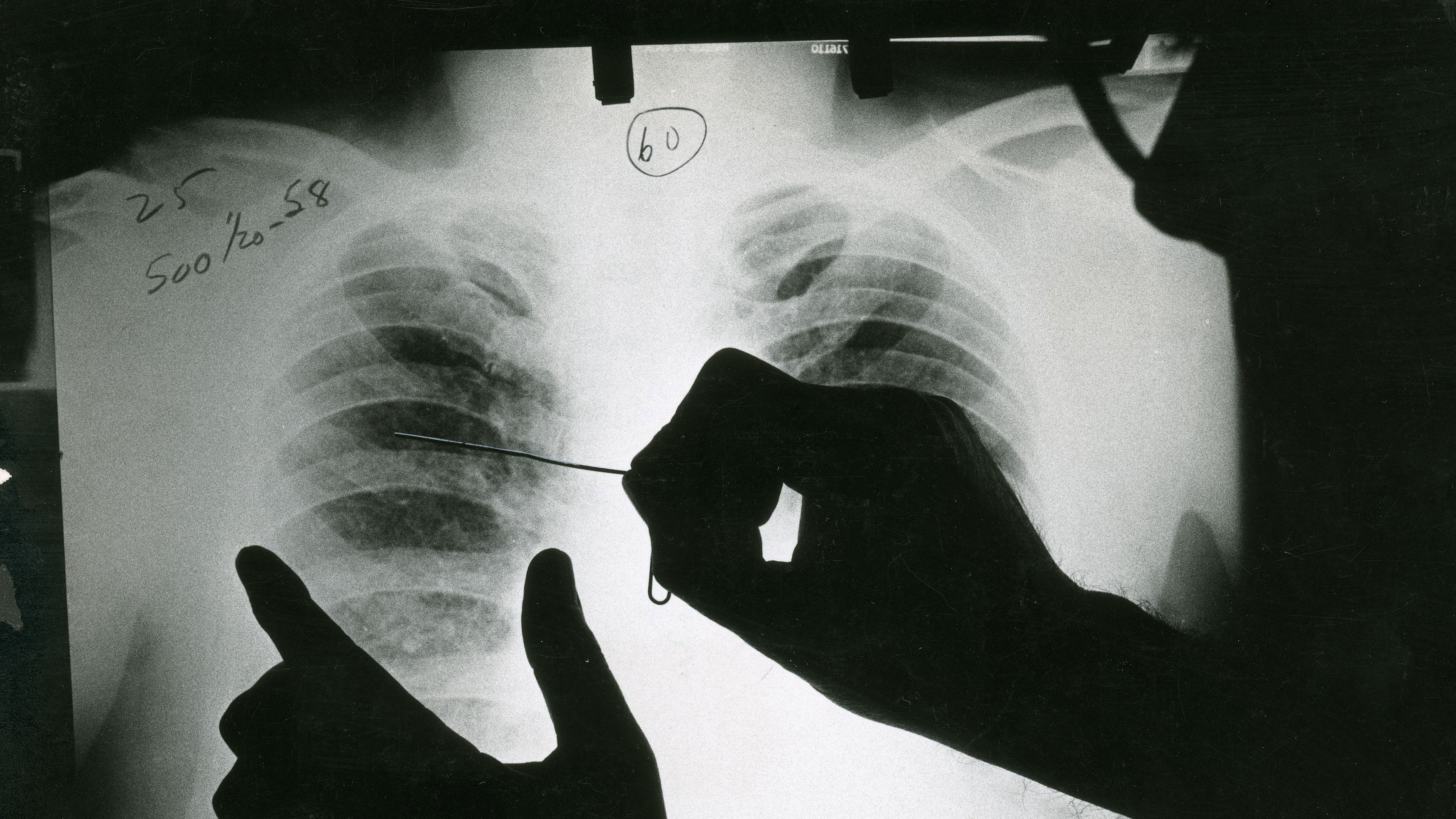In this historical image, a doctor reviews an X-ray of a patient with black lung disease. Federal researchers say they've now identified the largest cluster ever recorded of the most advanced stage of the disease. (Getty Images/Science Source)