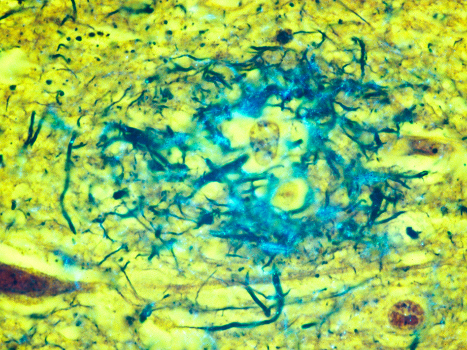 Plaques located in the gray matter of the brain are key indicators of Alzheimer's disease.