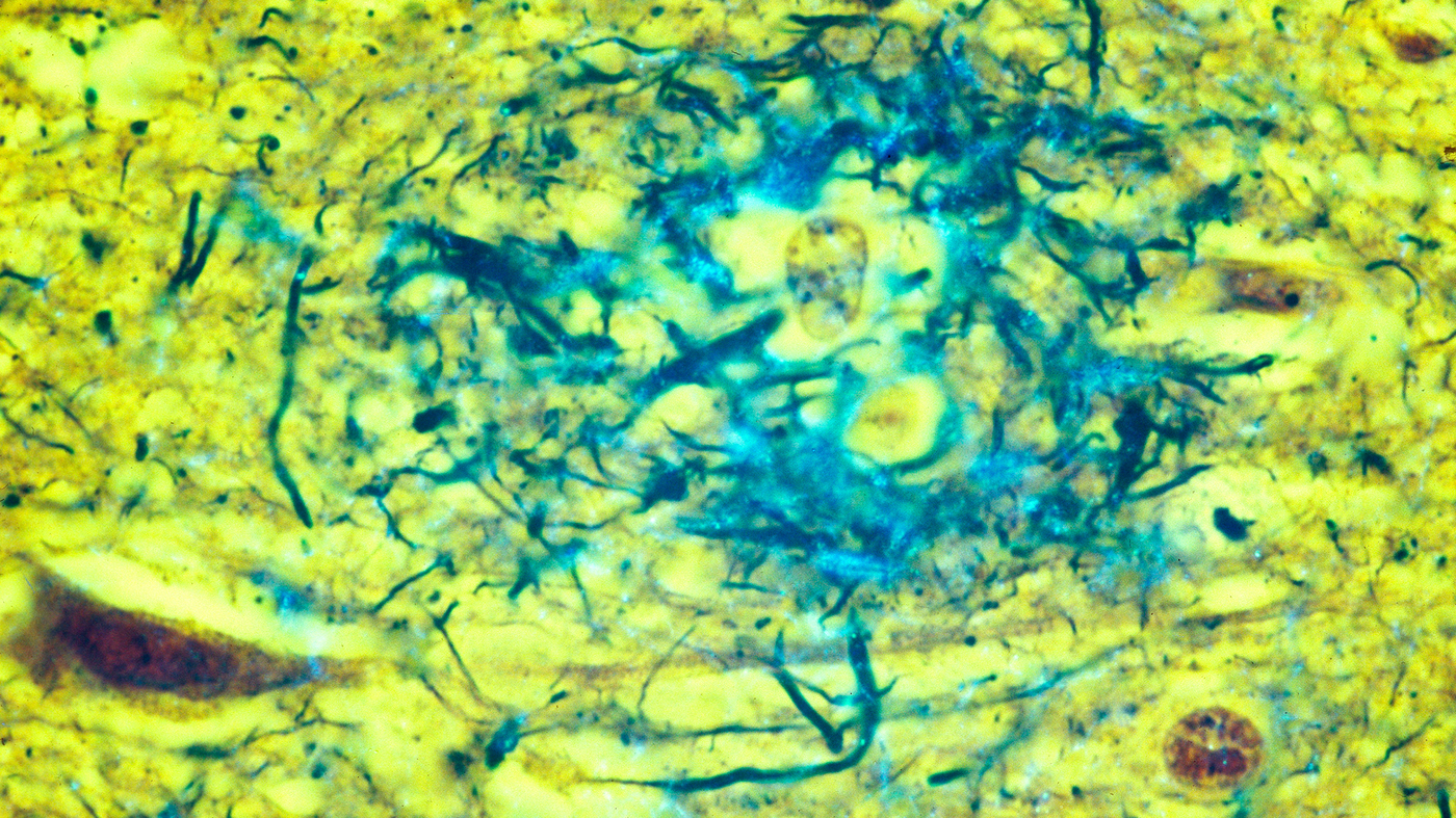 Scientists Push Plan To Change How Researchers Define Alzheimer's