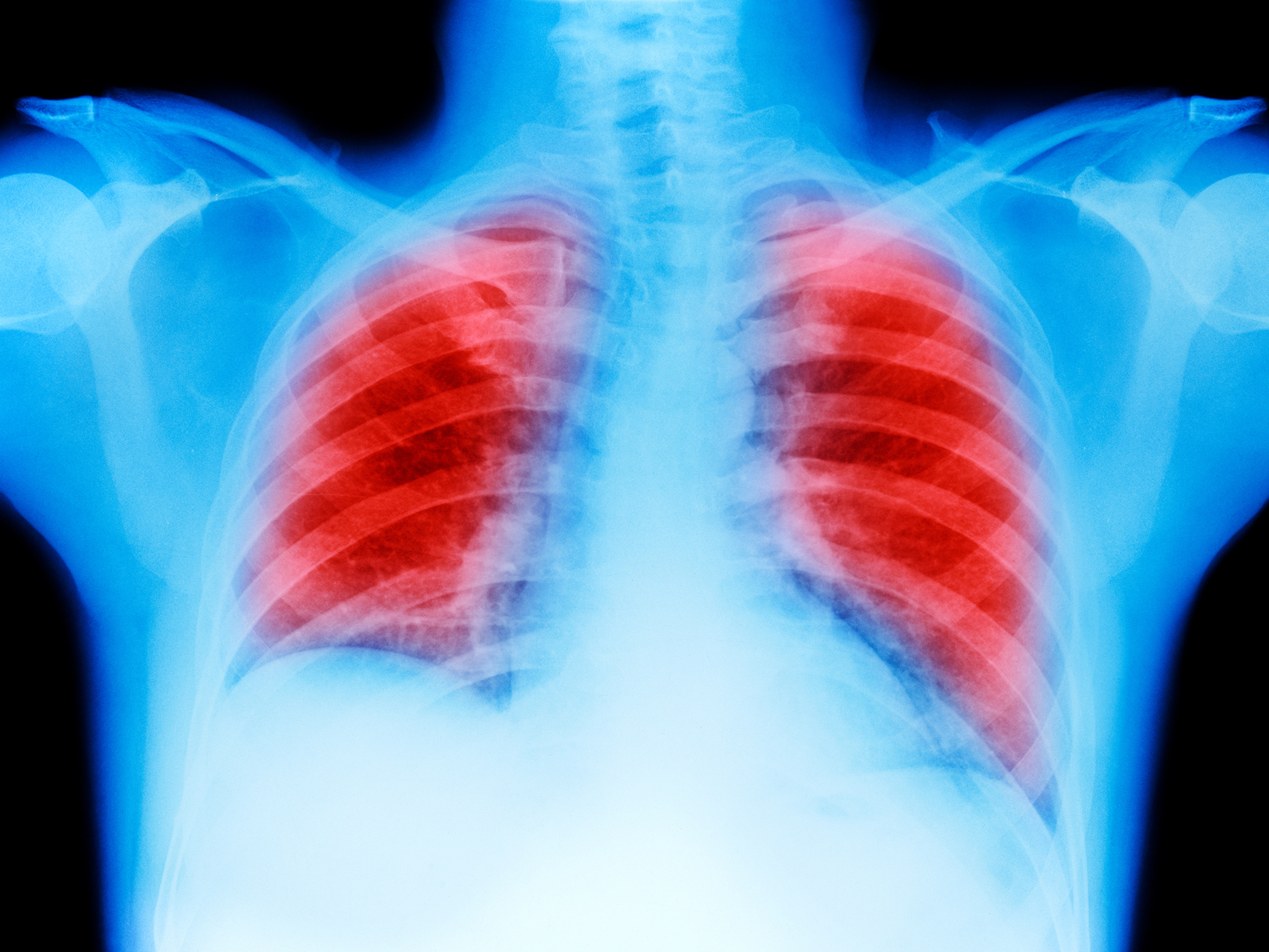 A combination of an immunotherapy drug from Merck and standard chemotherapy led to improved survival for cancer patients. (Getty Images)