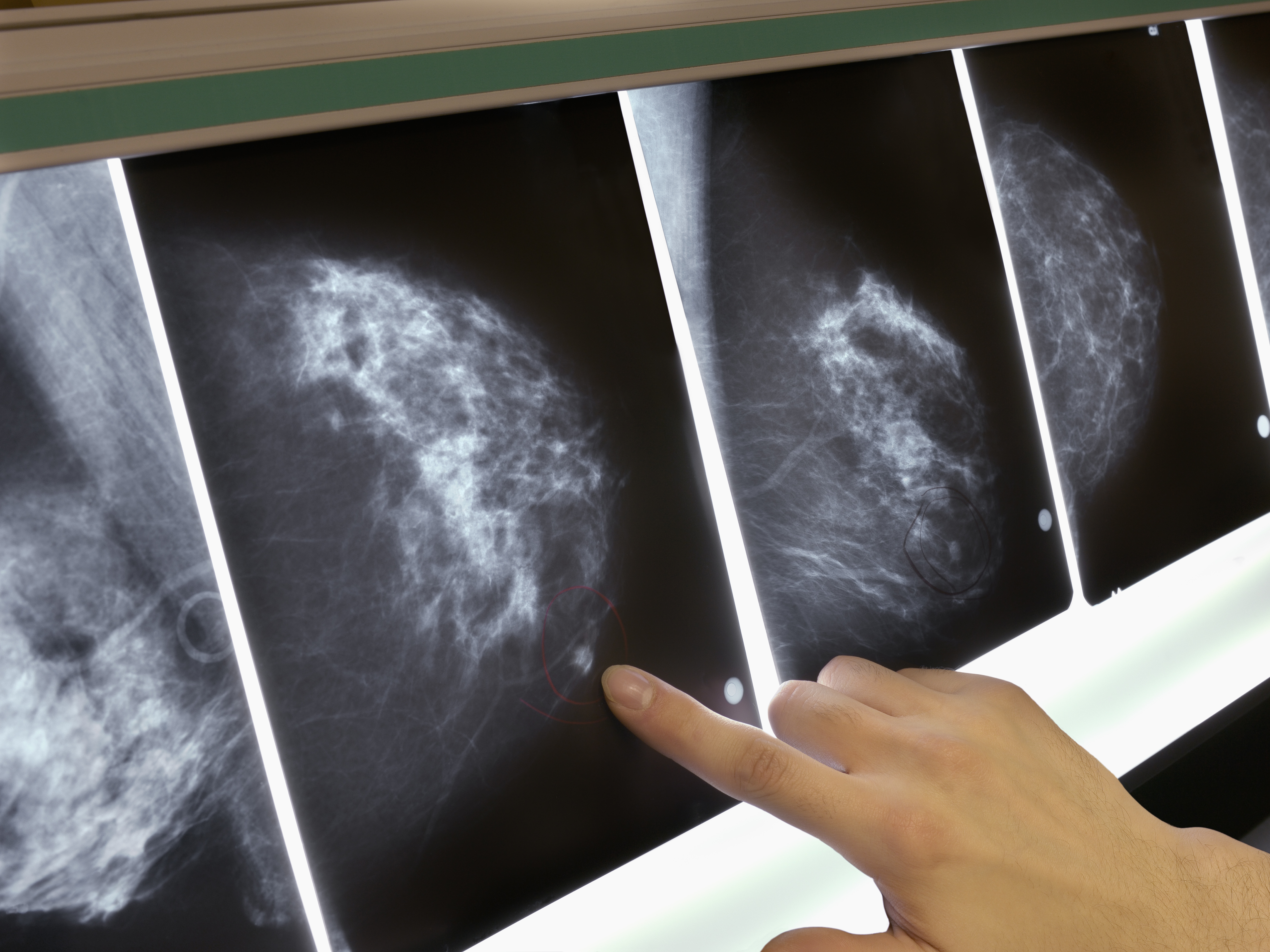 Women with a common form of breast cancer may be able to safely forgo chemotherapy, depending on the results of a genetic test. (Getty Images)