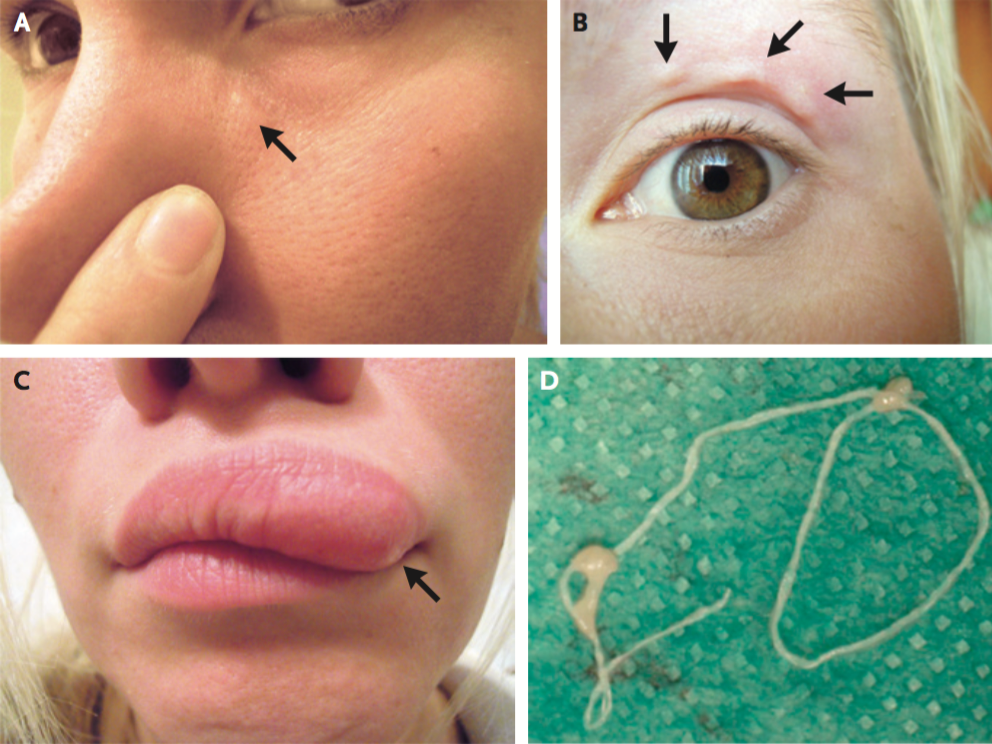 Hookworm In Human Eye