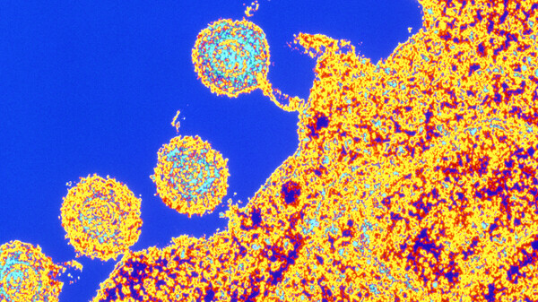 Several circular herpes virus particles are seen near a cell membrane. Roseola herpes virus causes a childhood illness marked by skin rashes and now has been found in brains with Alzheimer