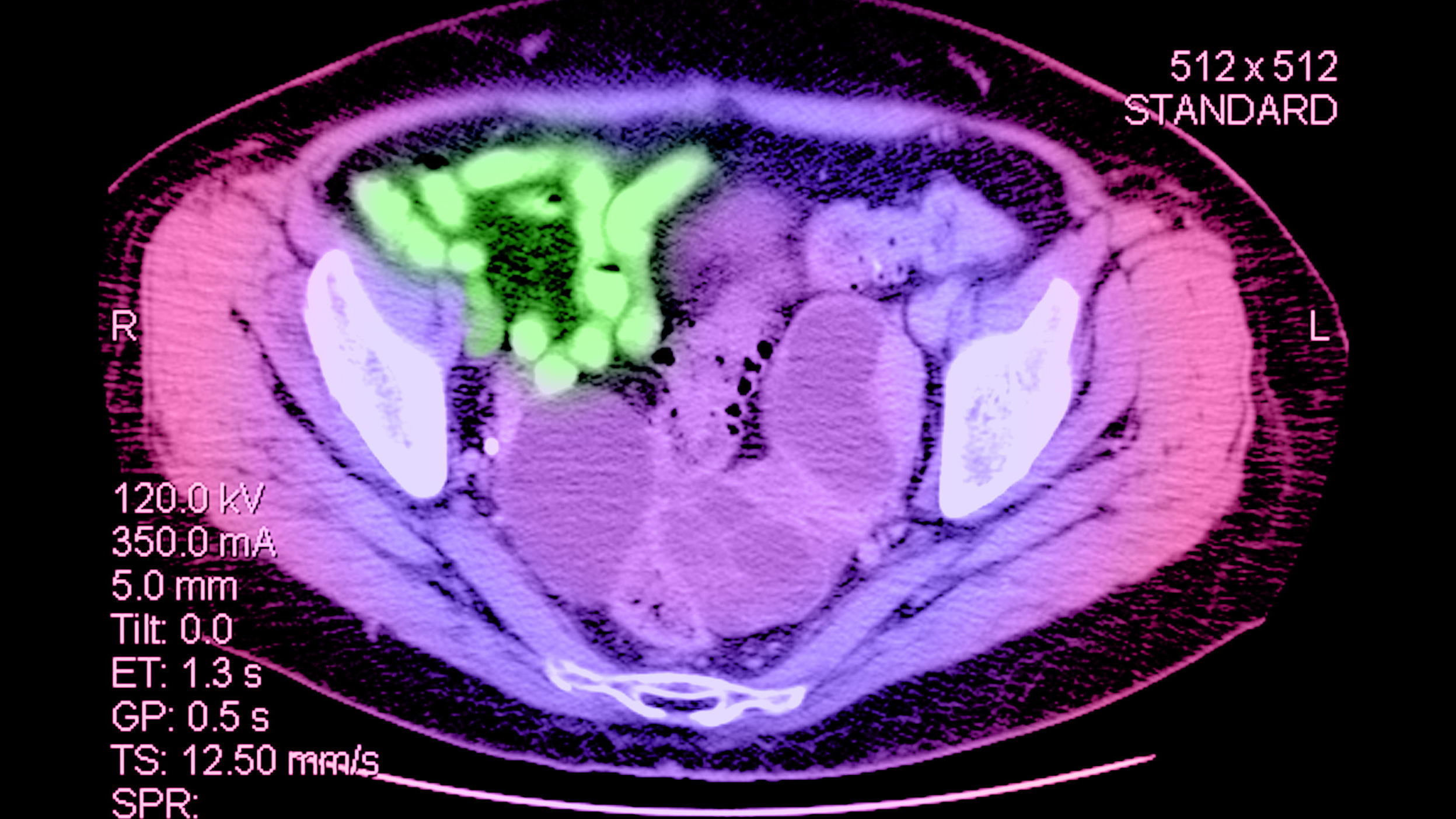 Report: Women Around The World Don't Know Enough About Ovarian Cancer ...