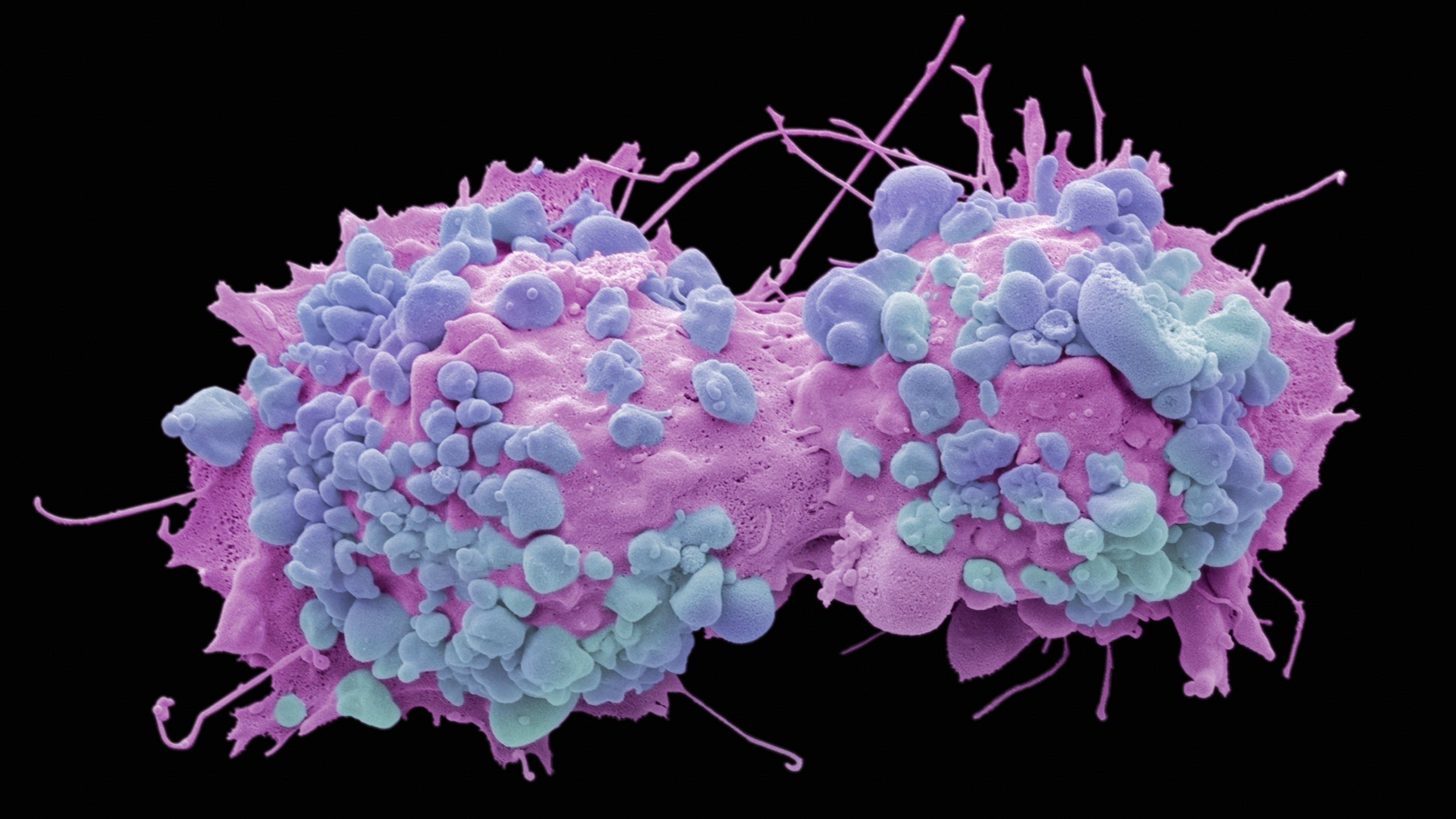 Colored scanning electron micrograph of dividing ovarian cancer cells.