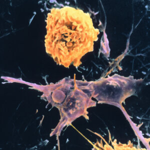Researchers Find A Web Of Factors Behind Multiple Sclerosis