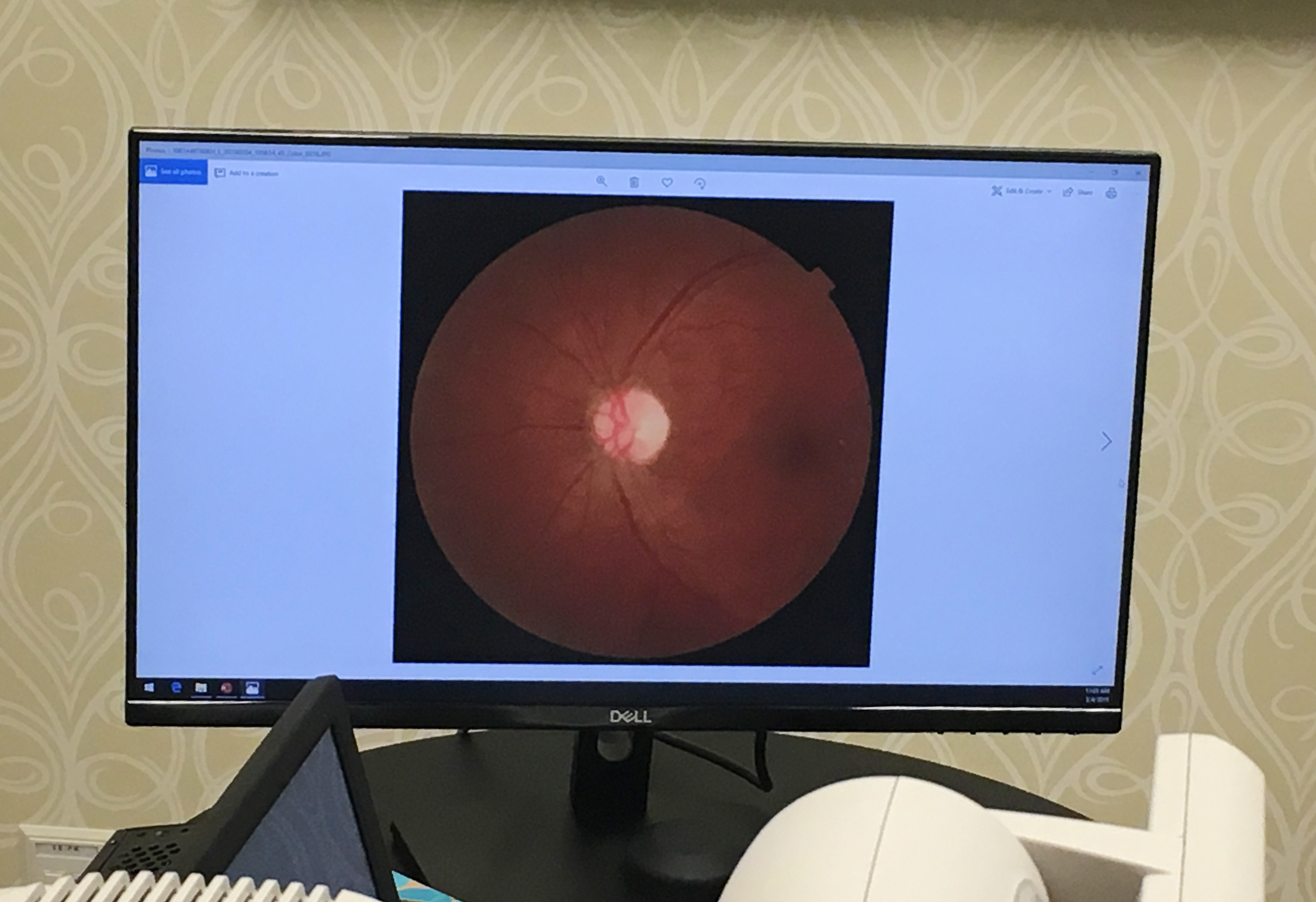 A retinal scan is displayed at University Medical Center in New Orleans using software detects is called diabetic retinopathy.