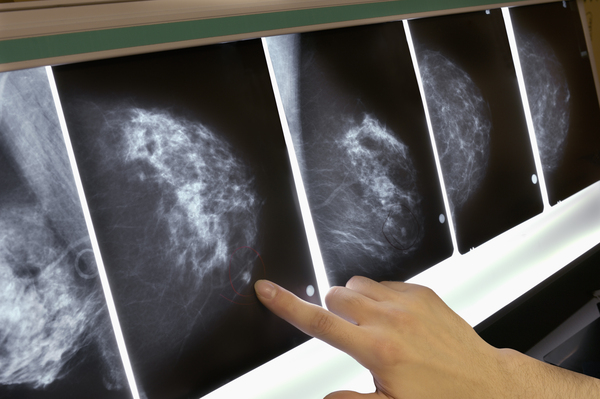 The out-of-pocket expense of mammograms, MRIs and other tests and treatments can be several thousand dollars each year when you have a high-deductible health policy.