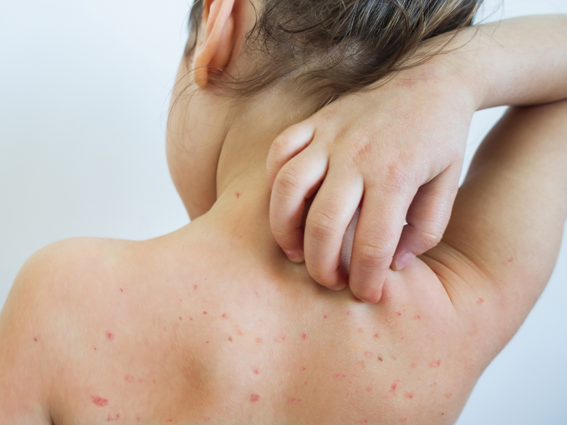 Measles used to be a common childhood disease, but after an effective vaccine was developed, the disease was declared eliminated in the U.S. in 2000. This year's outbreaks, however, put that status in jeopardy. (Getty Images)