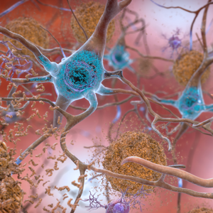 New Markers For Alzheimer's Disease Could Aid Diagnosis And Speed Up Drug Development