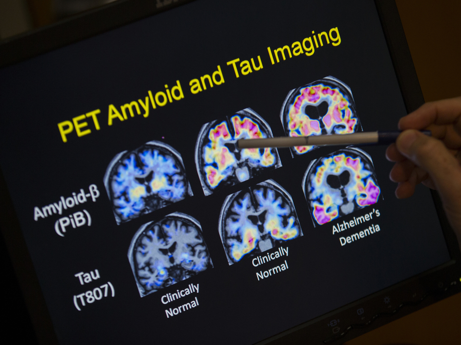 In a May 19, 2015 file photo, R. Scott Turner, Professor of Neurology and Director of the Memory Disorder Center at Georgetown University Hospital, points to PET scan results that are part of a study on Alzheimer's disease at Georgetown University Hospital, in Washington. (Evan Vucci/AP)