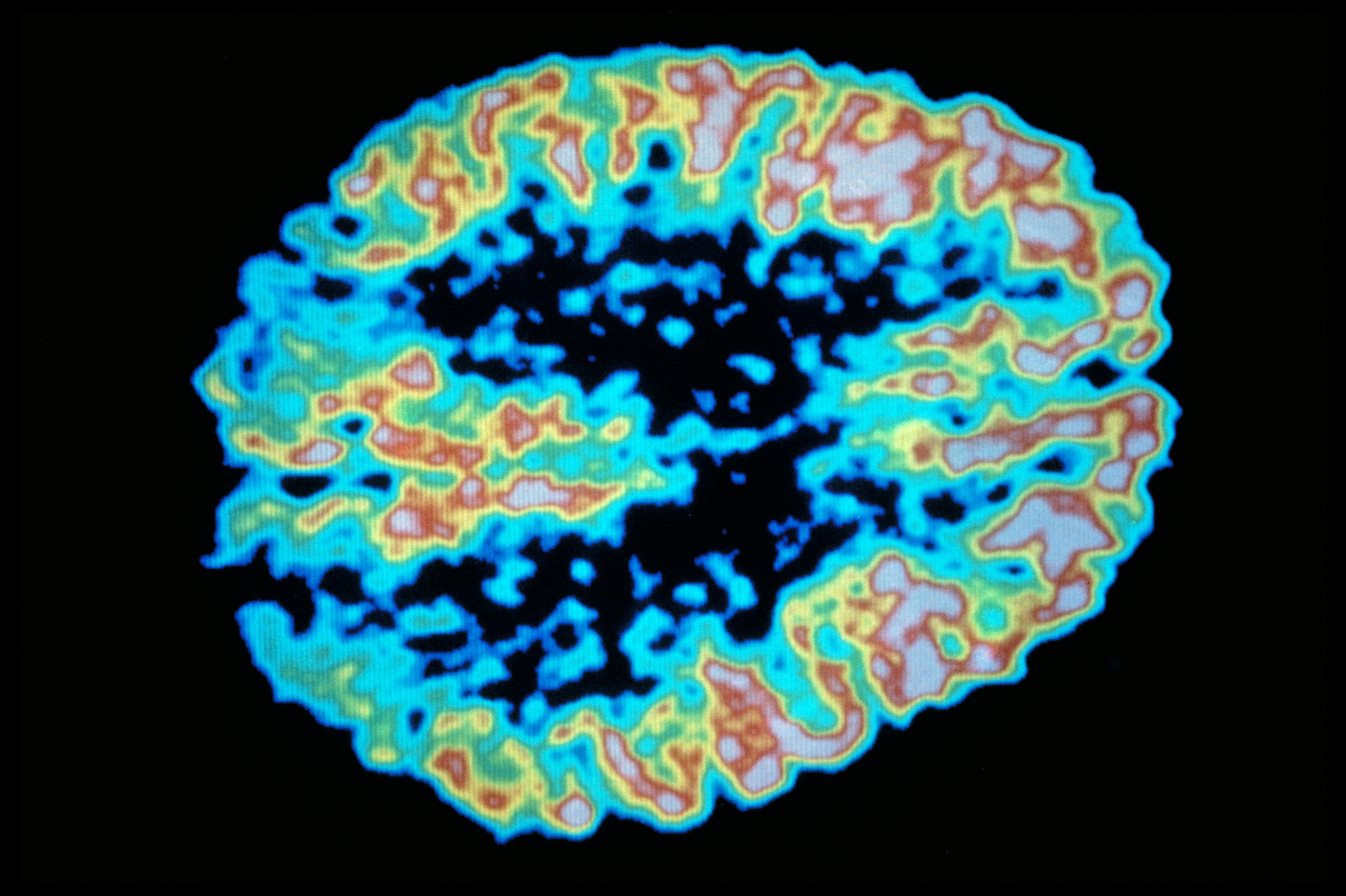 A PET scan shows metabolism of sugar in the human brain. (Science Source)
