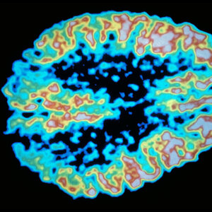 Keeping Your Blood Sugar In Check Could Lower Your Alzheimer's Risk