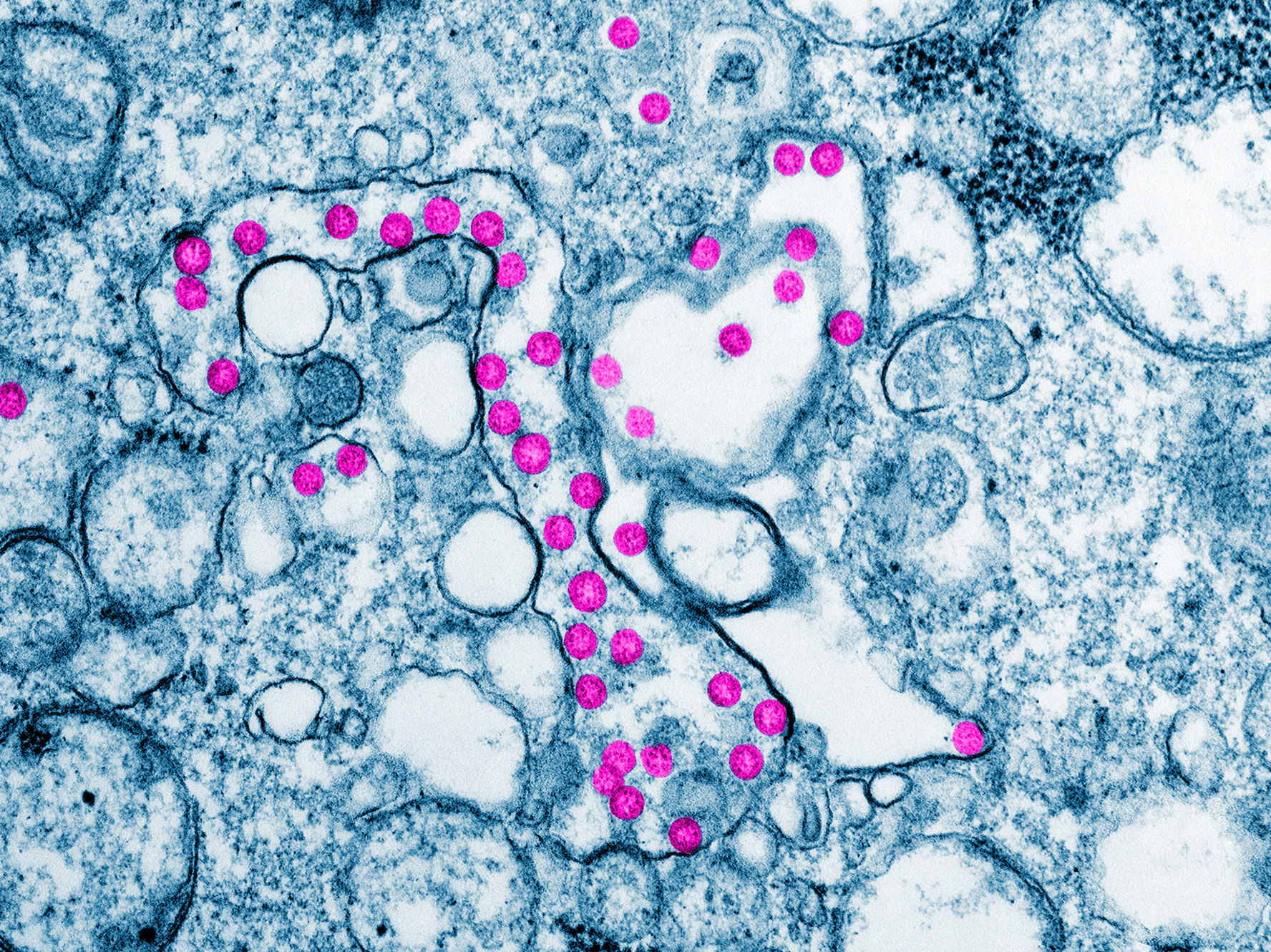 Viral particles are colorized purple in this color-enhanced transmission electron micrograph from a COVID-19 patient in the United States. Computer modeling can help epidemiologists predict how and where the illness will move next. (Hannah A Bullock and Azaibi Tamin/CDC/Science Source)