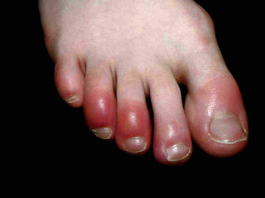 From Loss Of Smell To 'COVID Toes': What Experts Are Learning About Symptoms 3 From Loss Of Smell To 'COVID Toes': What Experts Are Learning About Symptoms 2