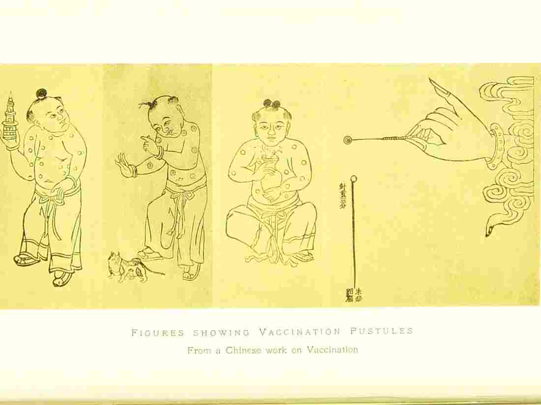 The origin of the vaccine can be traced back to smallpox inoculation in Imperial China. This Chinese illustration, found in a 1913 textbook, shows the method.