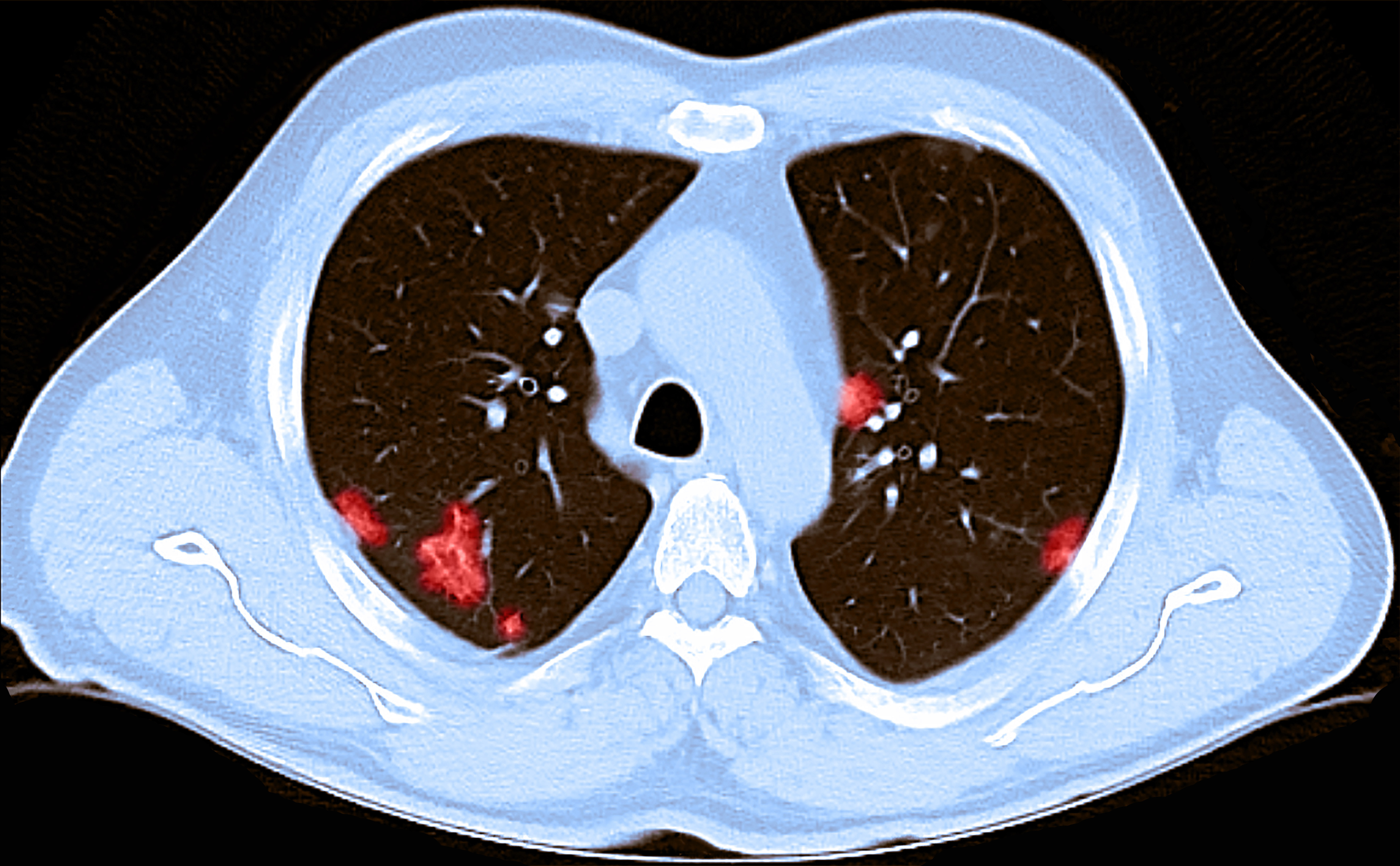 Image Of Coronavirus Lung