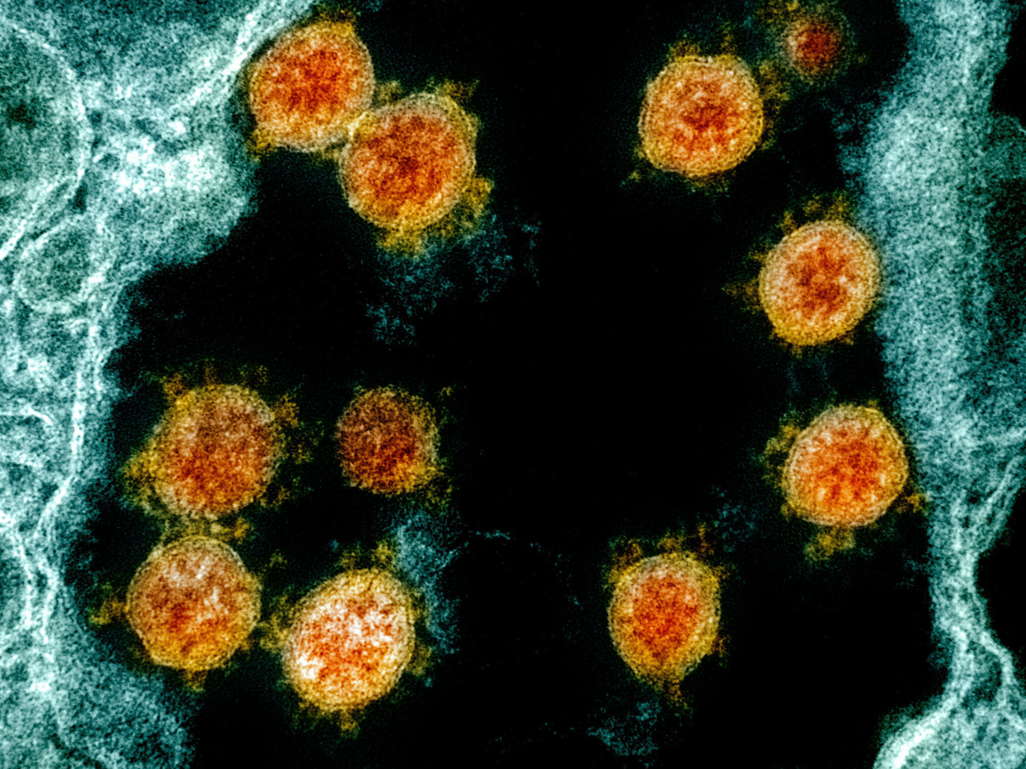 Internationally, scientists now<strong data-stringify-type=&quot;bold&quot;> </strong>have on file the genomes of more than 47,000 different samples of the virus that causes COVID-19 — up from just one in January. Here's a transmission electron micrograph of SARS-CoV-2 virus particles (orange) isolated from a patient. (National Institute of Allergy and Infectious Diseases/National Institutes of Health)