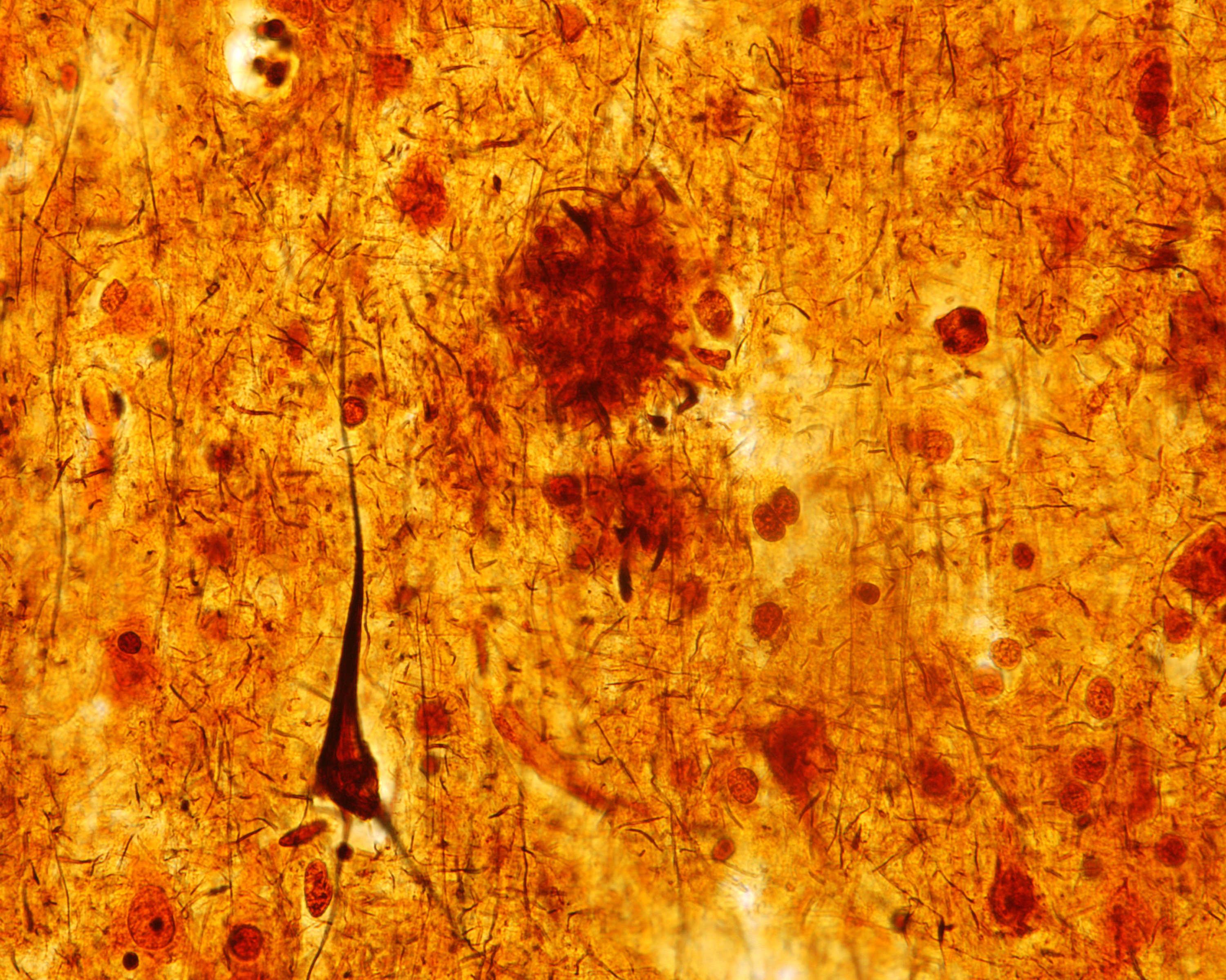 This light micrograph from the brain of someone who died with Alzheimer's disease shows the plaques and neurofibrillary tangles that are typical of the disease. A glitch that prevents healthy cell structures from transitioning from one phase to the next might contribute to the tangles, researchers say. (Jose Luis Calvo/ Science Source)