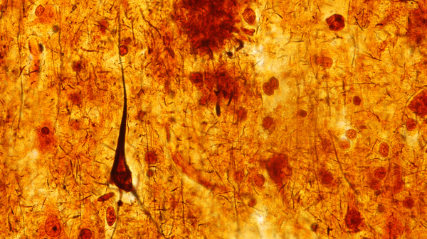 This light micrograph from the brain of someone who died with Alzheimer