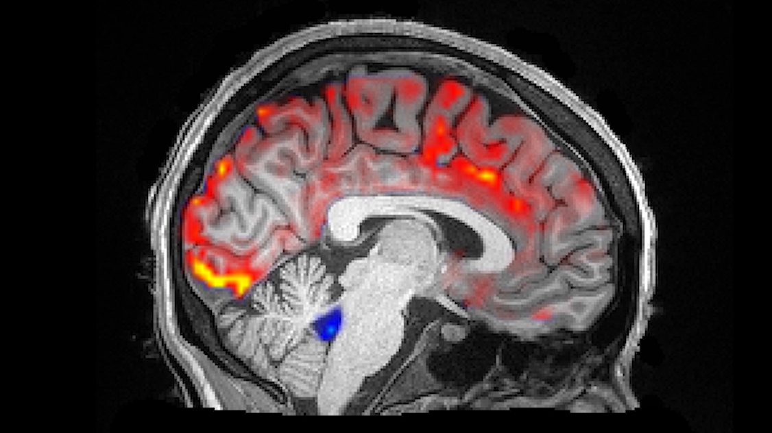 BRAIN SLEEP ハイ One More Step Toward Solving The Sleep & Alzheimer's Puzzle