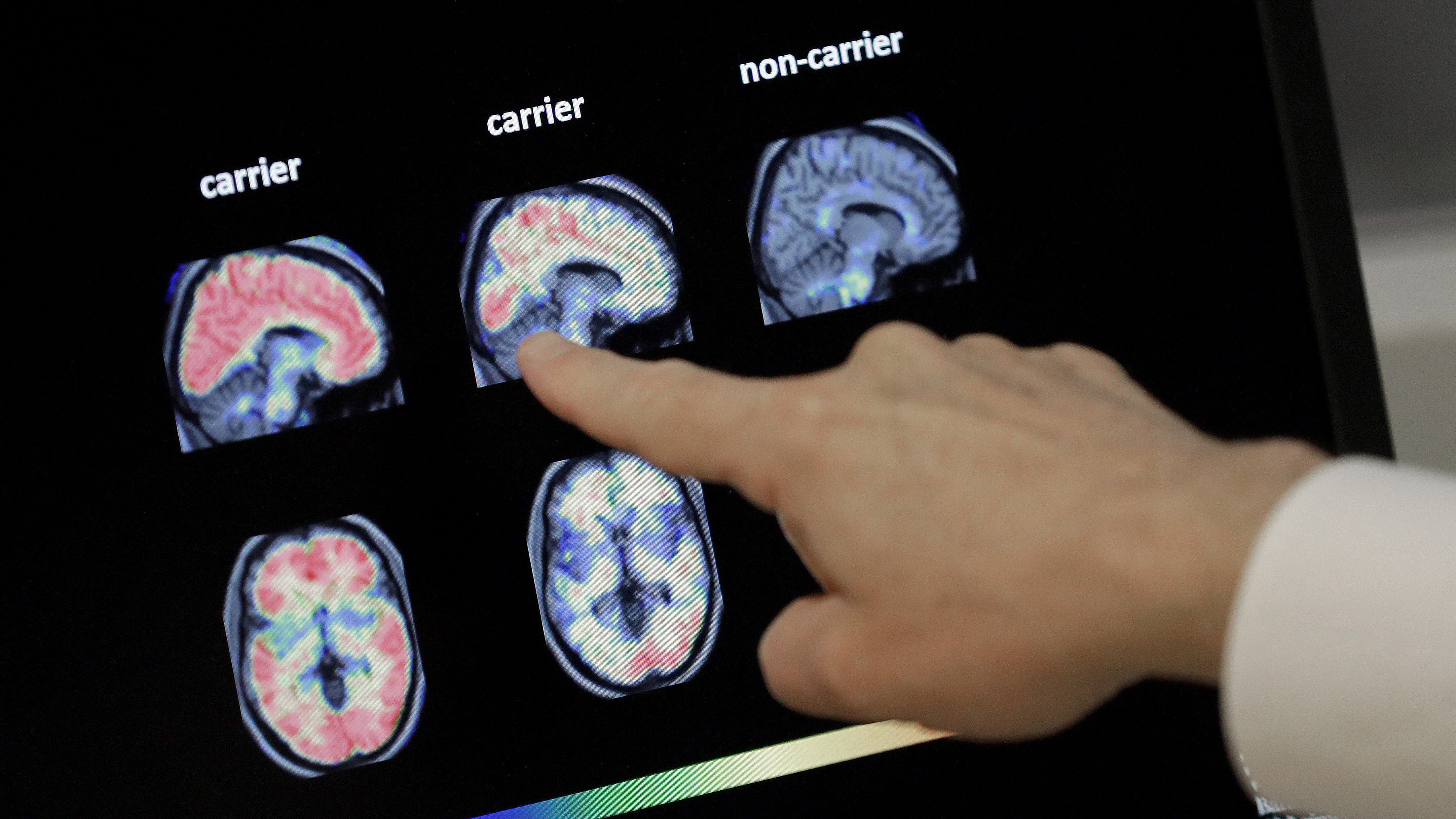 FDA Weighs Approval For Aducanumab To Fight Alzheimer's : Shots - Vimarsana News