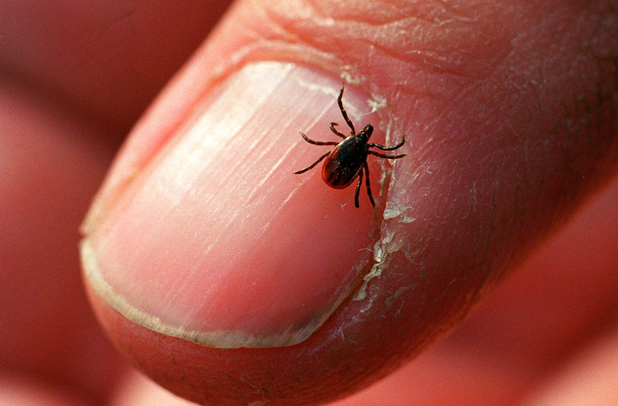 How to avoid ticks — and what to do if you get bitten : Shots - Health News  : NPR