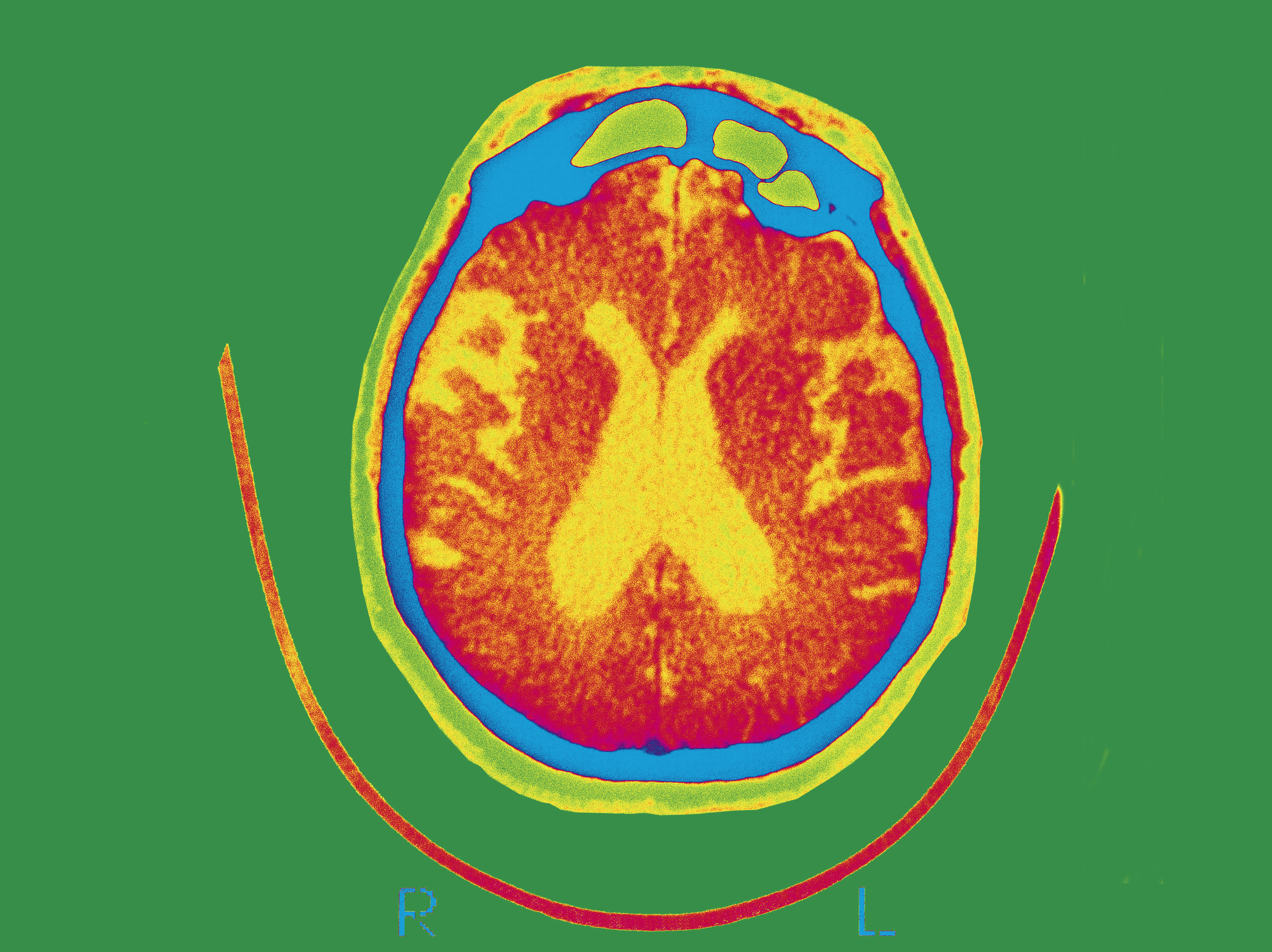 Scan Of The Brain Of A Patient Affected By Alzheimer's Disease Axial Section. The Food and Drug Administration approved aducanamab, the first drug to affect the underlying disease processes associated with Alzheimer's in June. (Universal Images Group via Getty)