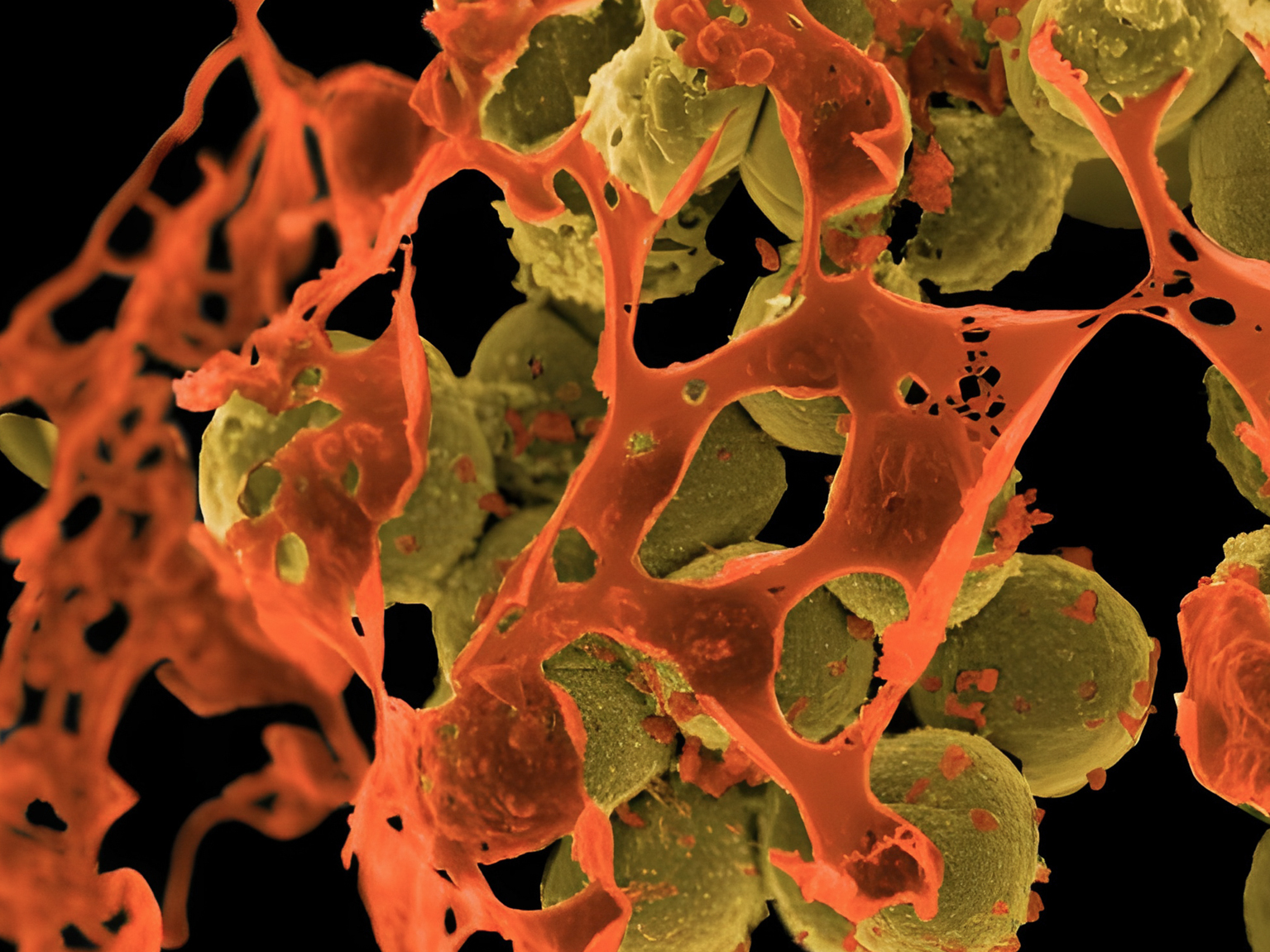 MRSA (methicillin-resistant <em>Staphylococcus aureus</em>), depicted above in yellow and surrounded by cellular debris, is a staph bacterium that resists treatment by many common antibiotics. The image is from a scanning electron micrograph. (NIH/NAID/IMAGE.FR/BSIP/Universal Images Group via Getty Images)