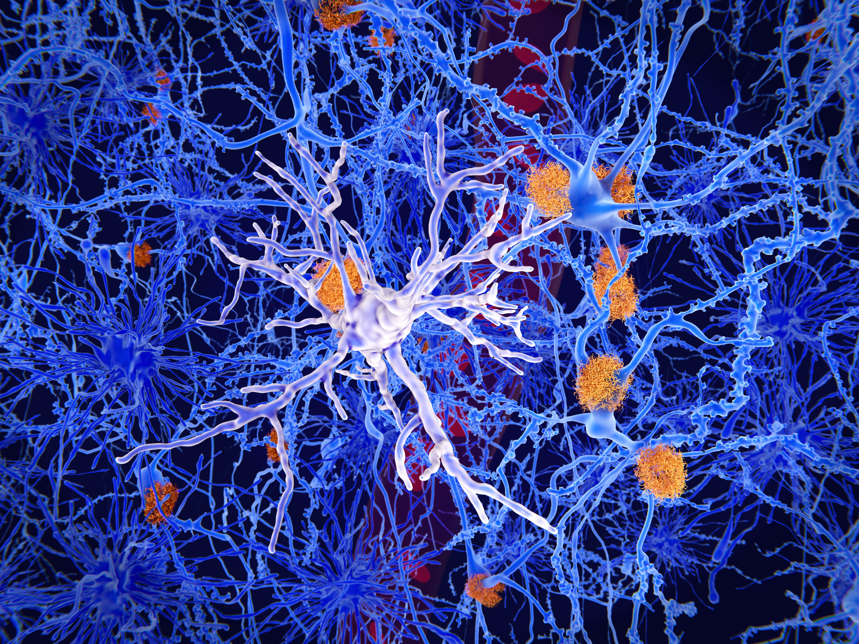 Microglia, specialized cells like the one seen in the center of this image, can restrain the accumulation of beta-amyloid protein (plaques in orange) that are a hallmark of Alzheimer's disease. But the cells sometimes contribute to the progression of the illness, researchers say. (Juan Gaertner/Science Source)