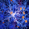 How a hyperactive cell in the brain might trigger Alzheimer's disease