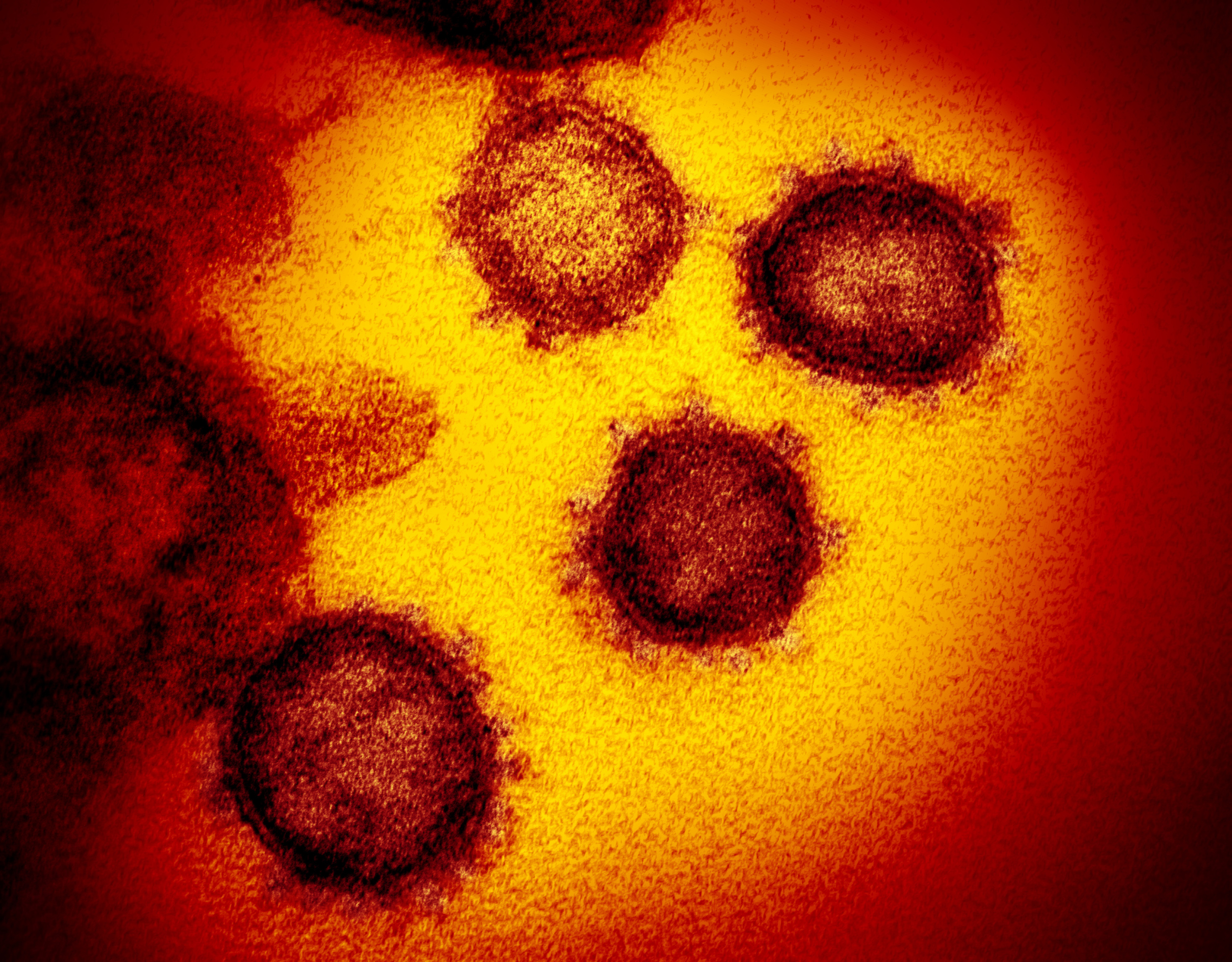 SARS-CoV-2 is shown in this colorized transmission electron micrograph. This specimen was isolated from a patient in the U.S. Particles of the virus are shown emerging from the surface of cells cultured in the lab. (Science Source)