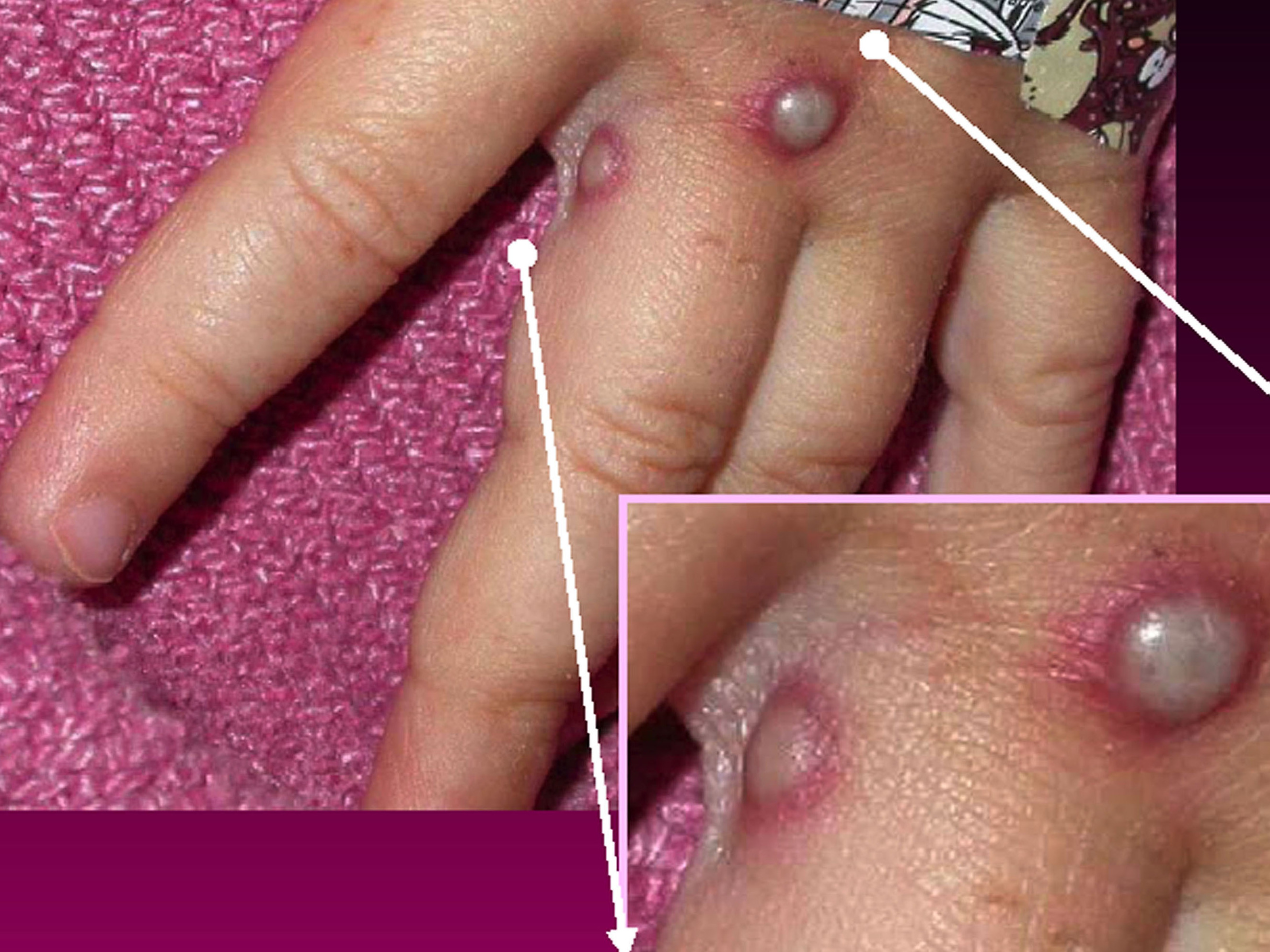 Rare monkeypox outbreak in U.K., Europe and U.S.: What is it and should we worry? - Vimarsana News