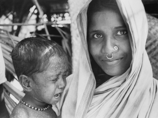 How Rahima came to hold a special place in smallpox history — and help