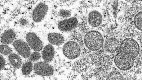 This 2003 electron microscope image made available by the Centers for Disease Control and Prevention shows mature, oval-shaped monkeypox virus particles, left, and spherical immature particles, right.